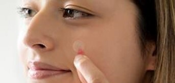 Nahaufnahme der Haut nahe dem Ohr, braune Haare, kleiner roter Fleck und Nexcare Anti-Akne-Patch, heller Hintergrund.
