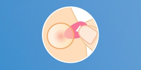 SCHRITT 2 – Pickel Patch mit der roten Lasche zur Haut hin auflegen
